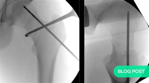 Proximal femoral fractures—acute management and indications 